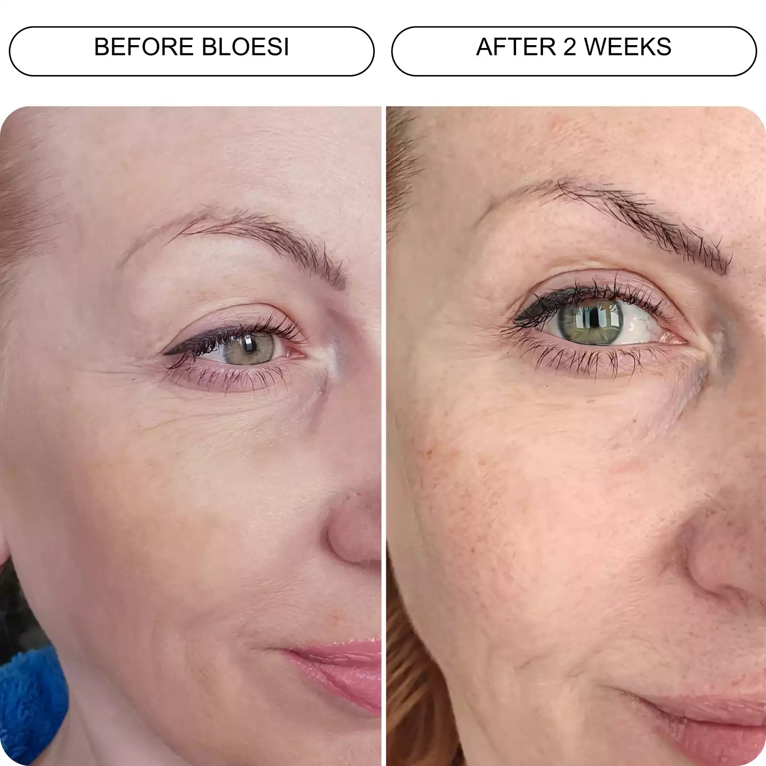 Microneedling Serum Infused Patches